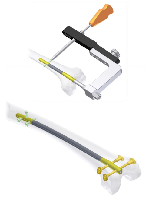 AMATOLA Supracondylar and Retrograde Nailing System