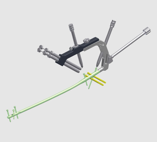MAKALU Expert Femur Nails - Antegrade & Retrograde Nailing System