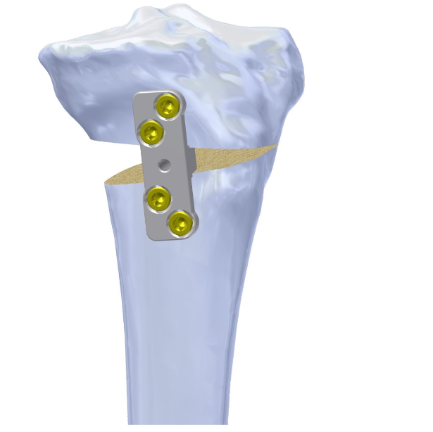 PUDU-X Opening Wedge Osteotomy VA Locking Plates 5.0mm
