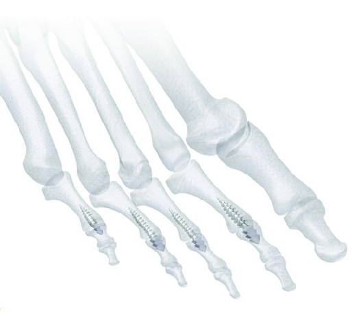 URANUS HammerToe Screws by Madison Ortho