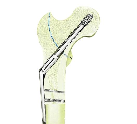 DCS and DHS Plates Dynamic Hip and Condylar Screw System