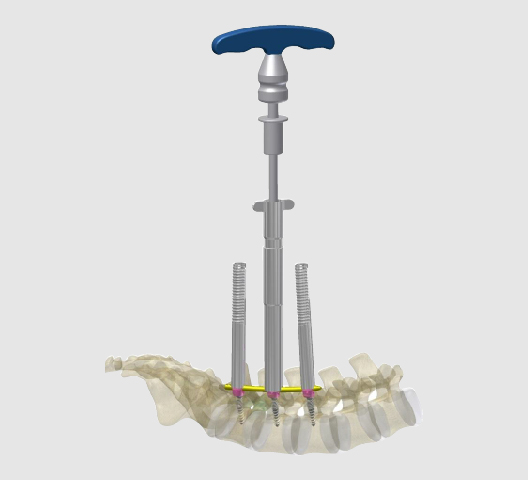 NEPTUNE 5.5 MIS Extended Tab Screws and Rods
