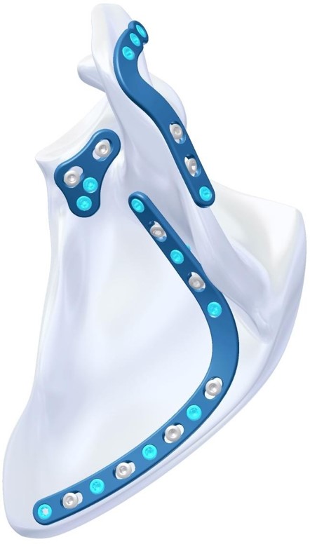 AMAZON LCP Scapula Locking Plates 3.5mm