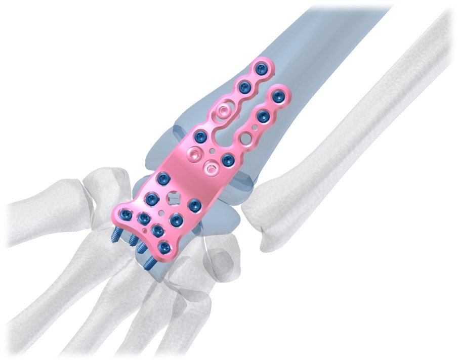 AMAZON VA Locking Wrist Arthrodesis Fusion System 2.4mm