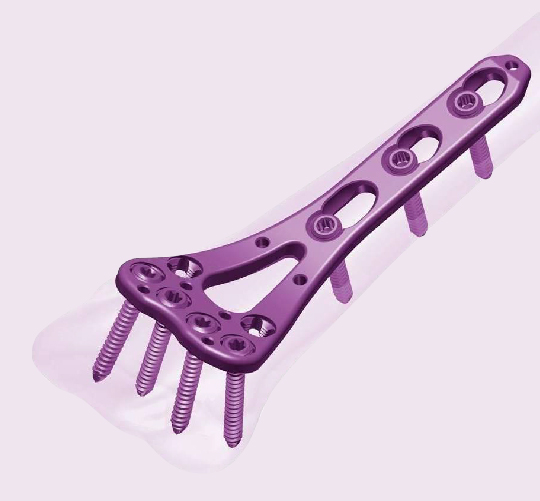 Locking Compression Plate Systems for trauma surgery
