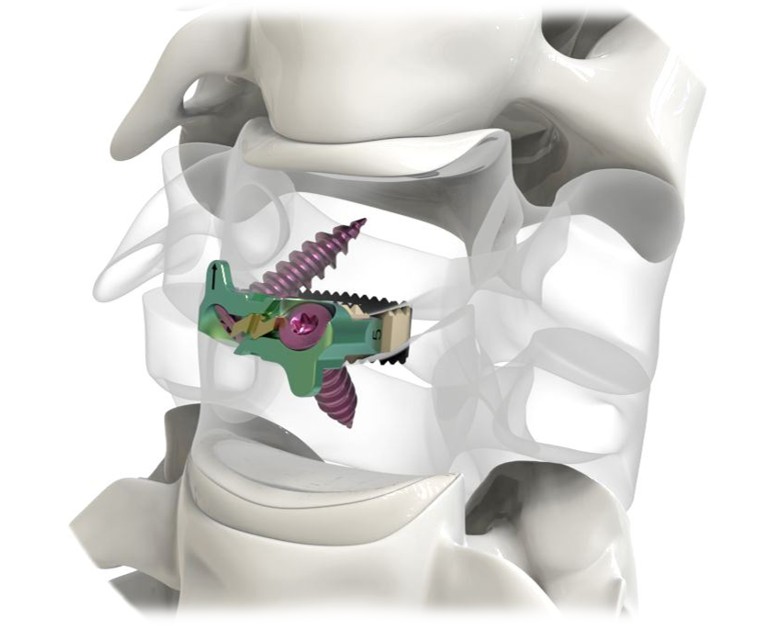 Minerva Variable Angle ACIF Cage