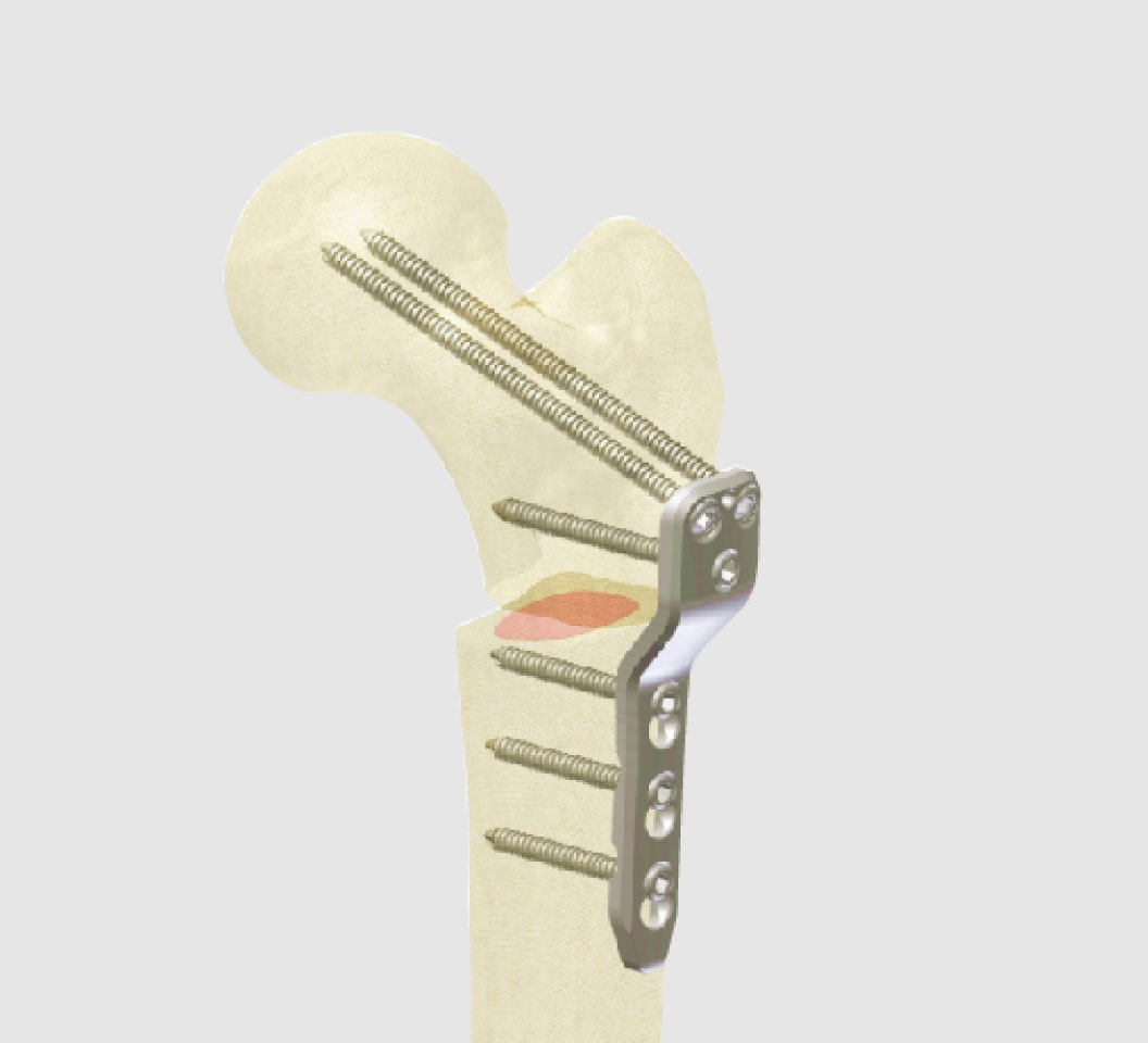 ASTRON Pediatric LCP Plates for hip reconstructive surgery