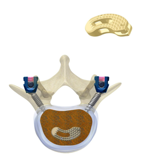 MERCURY PEEK Cage for Transforaminal Lumbar Interbody Fusion TLIF