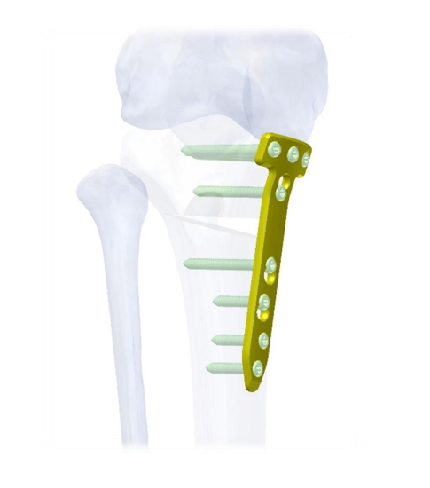 LENA Peri-Knee Osteotomy System for Femoral Alignment