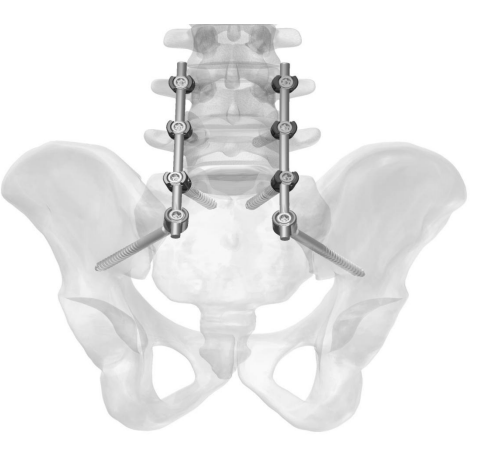 NEPTUNE-II Sacral Alar Iliac Fixation System