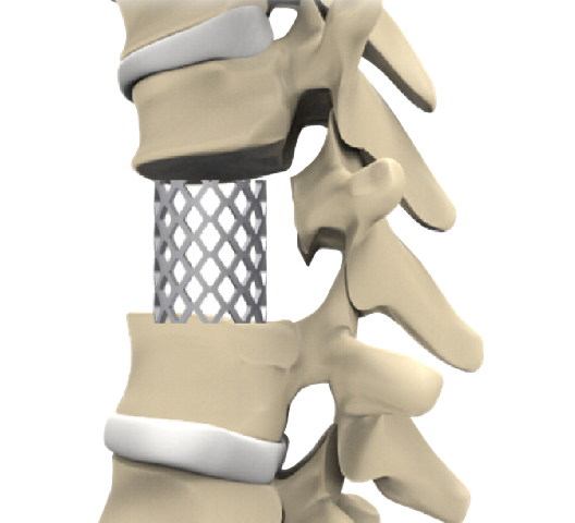 EARTH Titanium Mesh Cage for Spinal Reconstruction